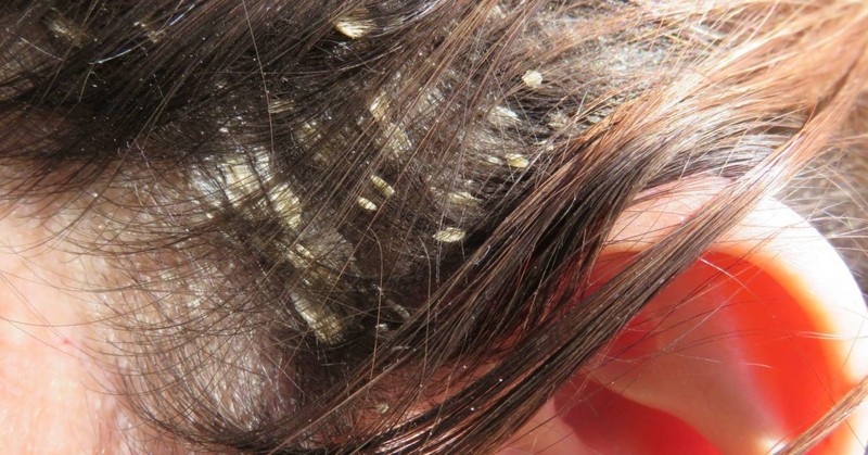 Is There A Cure For Seborrheic Dermatitis or Eczema On the Scalp?