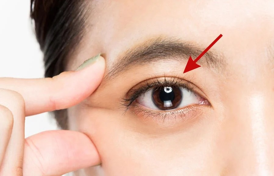 Do Double Eyelids Go Away With Surgery