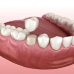 Restoring Strength And Confidence With Dental Crowns